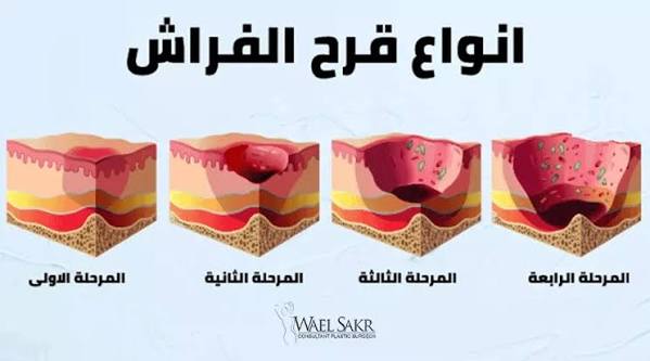 رسم طبي لأنواع قرح الفراش بمقطع عرضي للجلد - شكل قرحة الفراش