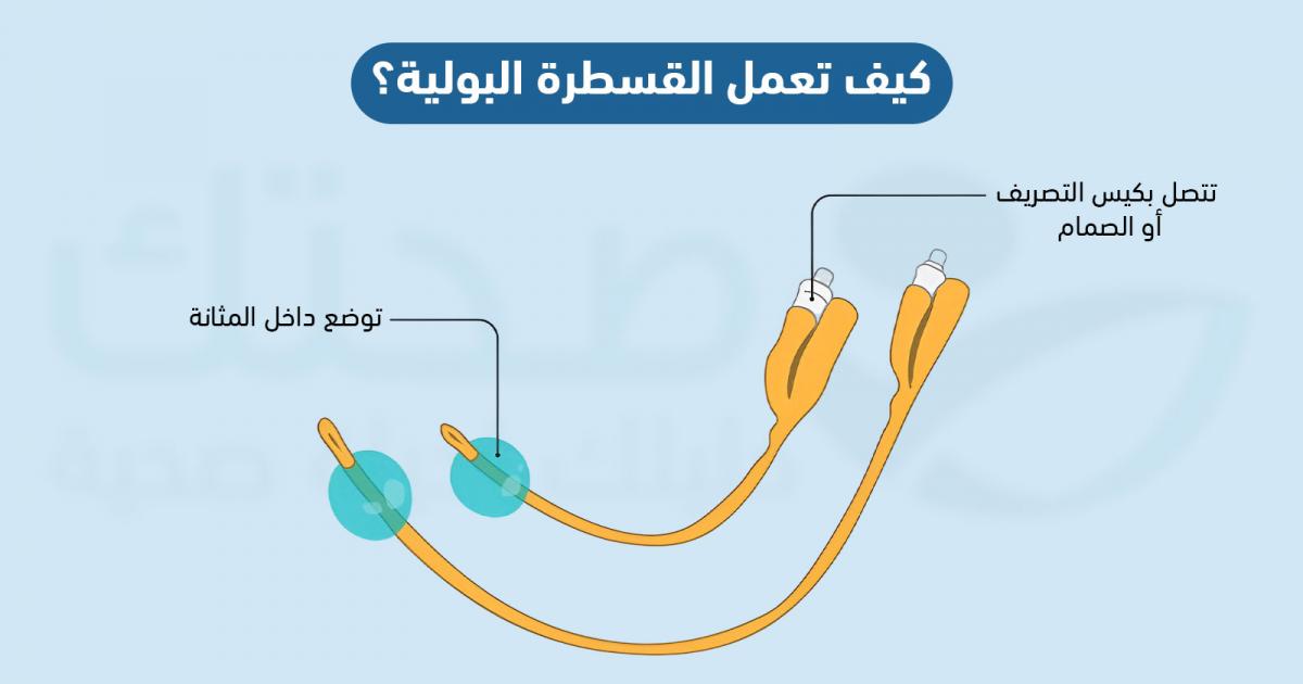 رسم توضيحي لأجزاء القسطرة البولية: البالون داخل المثانة والطرف المتصل بكيس التصريف